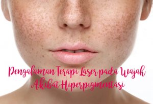 hyperpigentasi