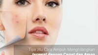 Tips Jitu Cara Ampuh Menghilangkan Jerawat dengan Cepat dan Aman